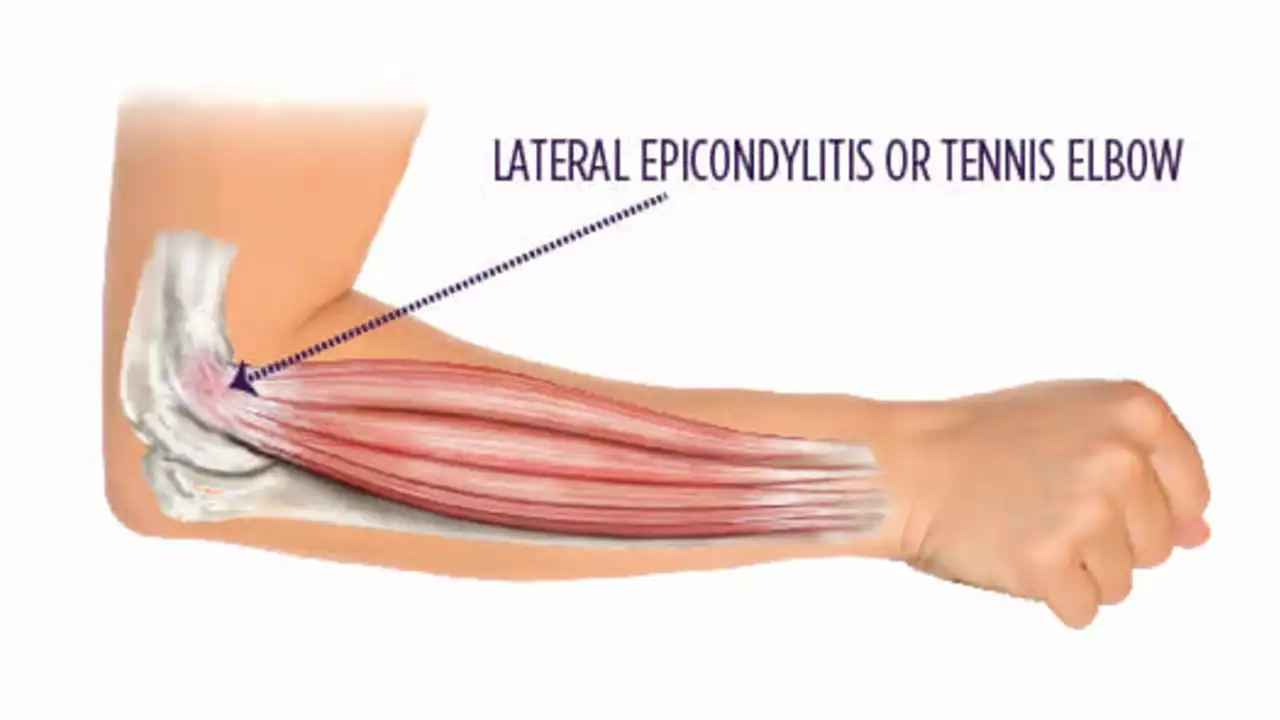 Tennis Elbow (Lateral Epicondylitis) An Overview?